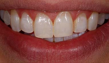 After - Altondental