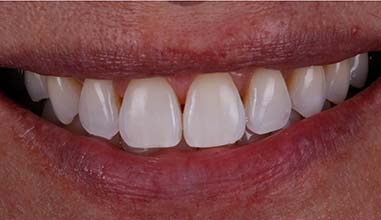 After - Altondental