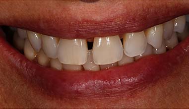 Before - Altondental