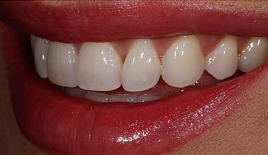 After - Altondental Dental