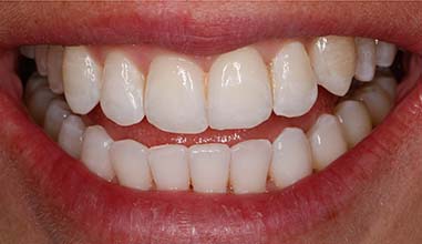 After - Altondental Dental