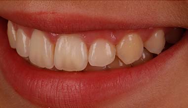 After - Altondental Dental