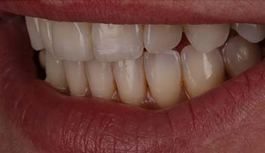 After - Altondental