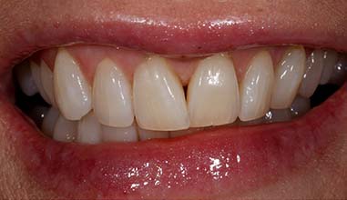 After - Altondental