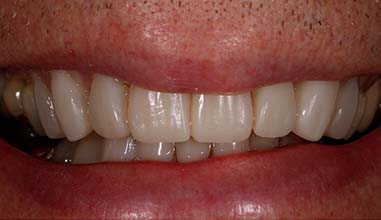 After - Altondental Dental