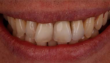 After - Altondental Dental