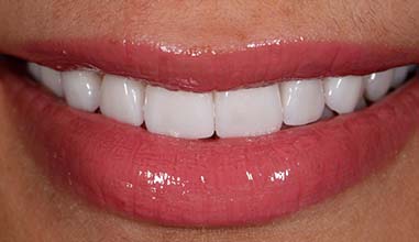 After - Altondental Dental