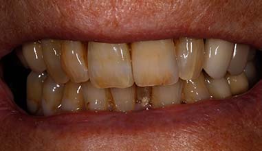 After - Altondental