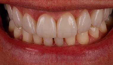 After - Altondental