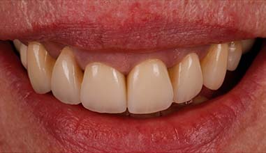 After - Altondental