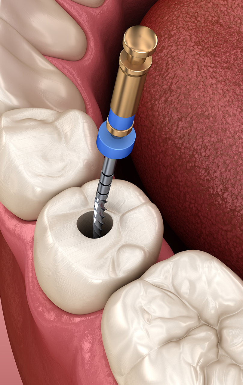 Treatment - altondental